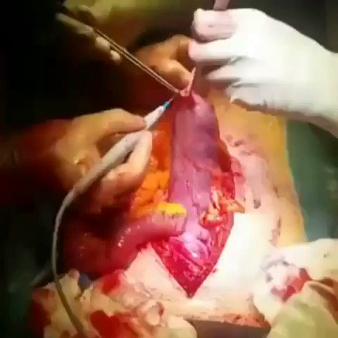 视频：结肠异物取出术